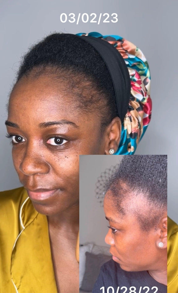 Hair & Edges -*Traction Alopecia*